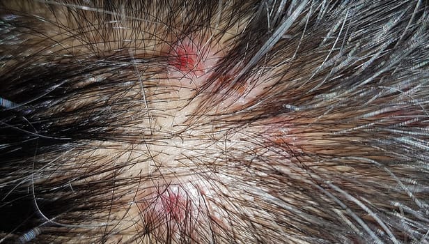 Scabs On The Scalp, wound on the scalps or Lichen planus follicularis capillitii, itch on the scalps, caused by diabetes on adults