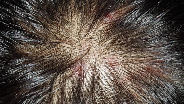 Scabs On The Scalp, wound on the scalps or Lichen planus follicularis capillitii, itch on the scalps, caused by diabetes on adults