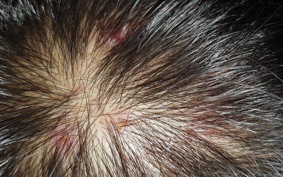 Scabs On The Scalp, wound on the scalps or Lichen planus follicularis capillitii, itch on the scalps, caused by diabetes on adults