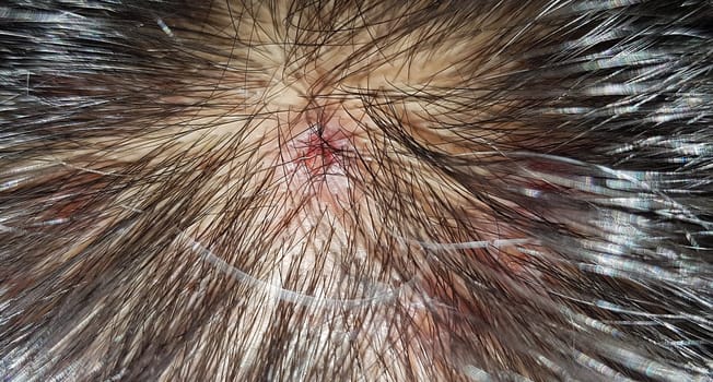Scabs On The Scalp, wound on the scalps or Lichen planus follicularis capillitii, itch on the scalps, caused by diabetes on adults