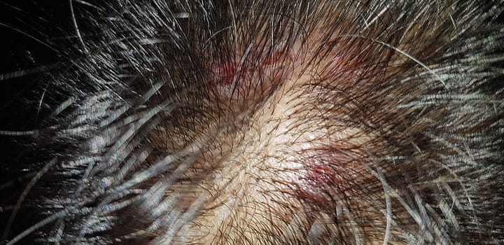 Scabs On The Scalp, wound on the scalps or Lichen planus follicularis capillitii, itch on the scalps, caused by diabetes on adults