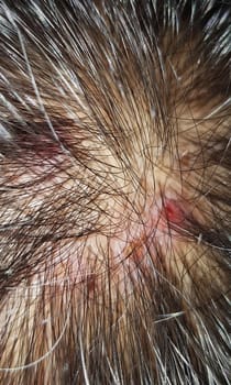 Scabs On The Scalp, wound on the scalps or Lichen planus follicularis capillitii, itch on the scalps, caused by diabetes on adults