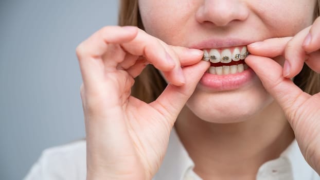 Close-up portrait of a red-haired girl touching braces. Young woman corrects bite with orthodontic appliance