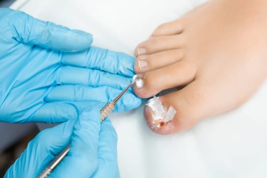 A foot care specialist podologist in blue gloves conducts a medical procedure on a womans toes at a medical center.
