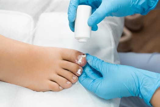 After the nail is removed, the podologist applies a powdery antiseptic to the toe for disinfection