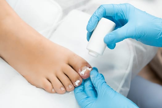 The foot specialist administers a dusty disinfectant to the toe following the extraction of the nail.