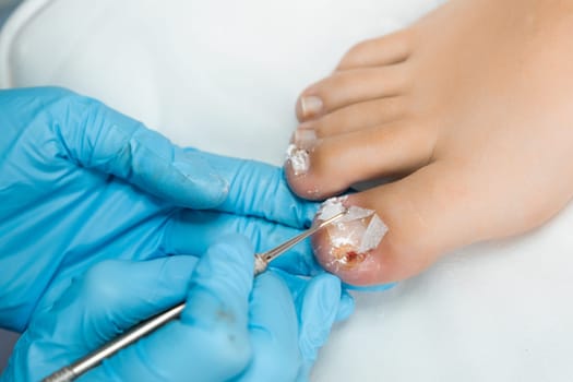 Podologist professional wearing blue gloves performs antifungal treatment on a womans toes in medical center.