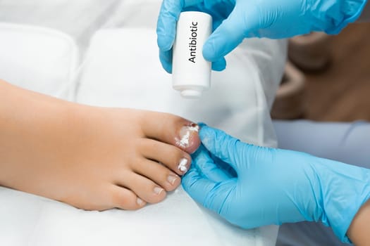 Podologist uses antibiotic powder after removal of ingrown toe nail.