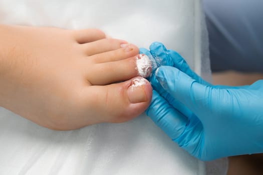 The toe receives a dusting of antiseptic powder from the podologist after nail removal