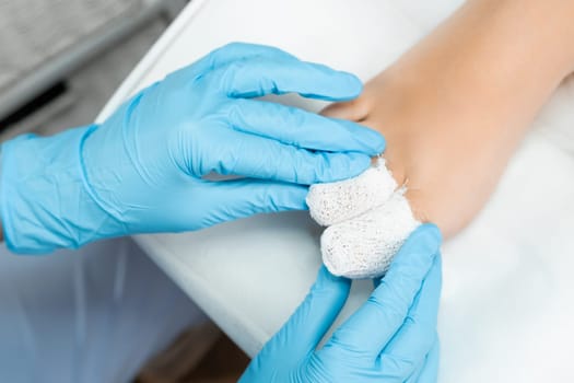 Podologist uses a bandage after applying antiseptic to the toe after removing the nail.