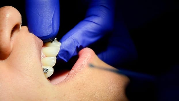 Dentist using shade guide to match tooth color during dental restoration