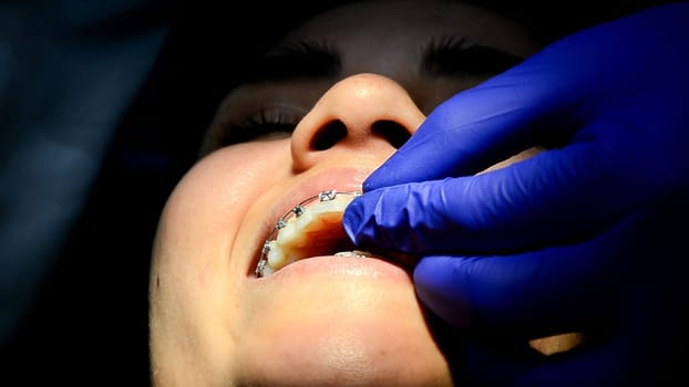 Close-up of a dentist adjusting braces on a patient during a dental checkup