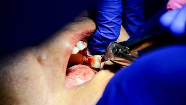 Close-up view of a professional dentist performing a dental surgery procedure with medical tools and equipment in a hygienic clinic setting, ensuring patient care and oral health