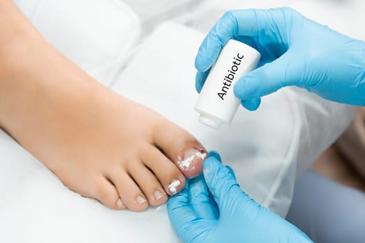 Podologist uses antibiotic after ingrown toenail removal.