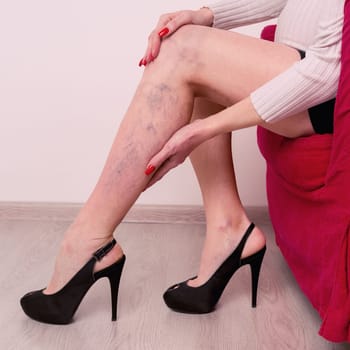 Painful varicose and spider veins on female legs during pregnancy. Woman massaging tired leg