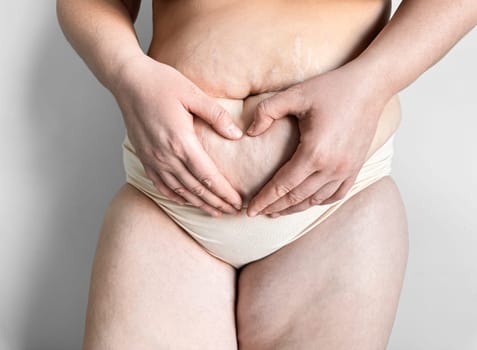 Postpartum woman making heart shape with hands on belly with stretch marks. Body positivity, self love, maternity, and post pregnancy concept. High quality photo