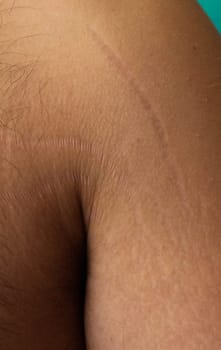 self-acceptance and care as you explore the topic of stretch marks on a man's arms and chest