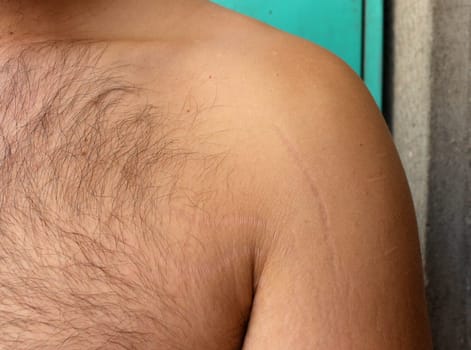 self-acceptance and care as you explore the topic of stretch marks on a man's arms and chest