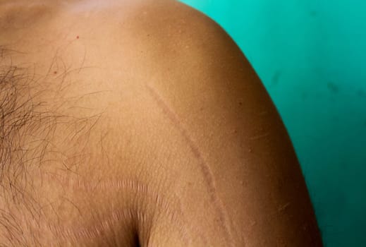 self-acceptance and care as you explore the topic of stretch marks on a man's arms and chest