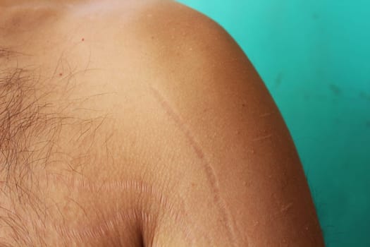 self-acceptance and care as you explore the topic of stretch marks on a man's arms and chest