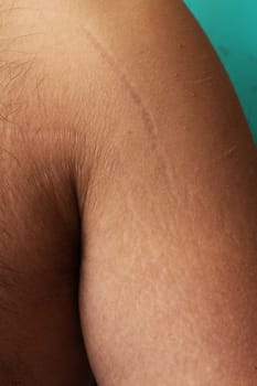 self-acceptance and care as you explore the topic of stretch marks on a man's arms and chest