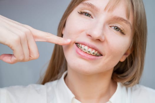 A beautiful red-haired girl smiles and points to the braces. Young woman corrects bite with orthodontic appliance.