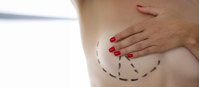 Woman covers her breast with her hand with preoperative marking with surgical marker in clinic. Plastic surgery and aesthetic medicine concept.