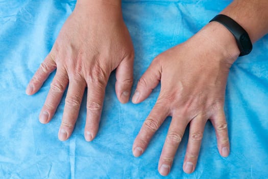 Close-up of hands with very bad skin condition, cracked skin on hands on a blue background. Dermatitis, psoriasis