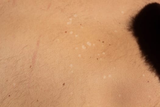 Capture the visual complexity of tinea versicolor, a common fungal skin infection, with this high-resolution stock image