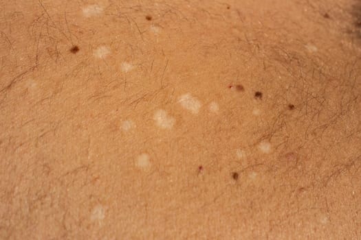 Capture the visual complexity of tinea versicolor, a common fungal skin infection, with this high-resolution stock image