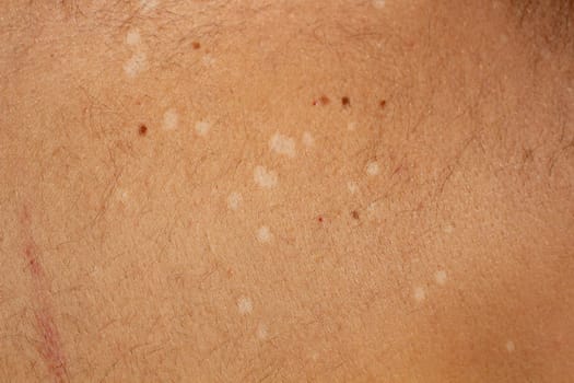 Capture the visual complexity of tinea versicolor, a common fungal skin infection, with this high-resolution stock image