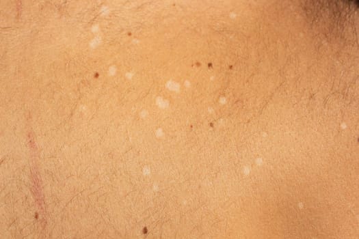 Capture the visual complexity of tinea versicolor, a common fungal skin infection, with this high-resolution stock image