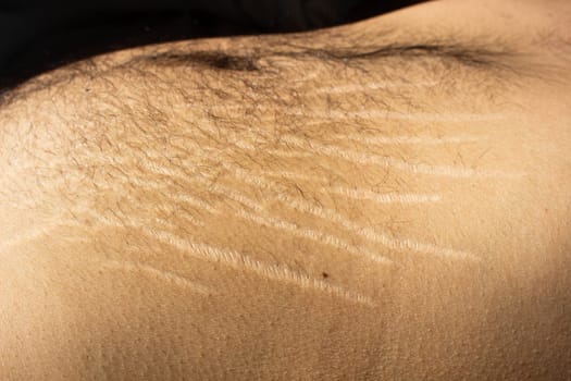 Explore the impact of weight changes, including obesity and muscle gain, on the male body through this compelling stock image capturing stretch marks