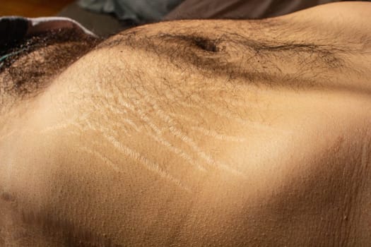 Explore the impact of weight changes, including obesity and muscle gain, on the male body through this compelling stock image capturing stretch marks