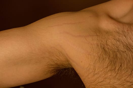 Explore the impact of weight changes, including obesity and muscle gain, on the male body through this compelling stock image capturing stretch marks