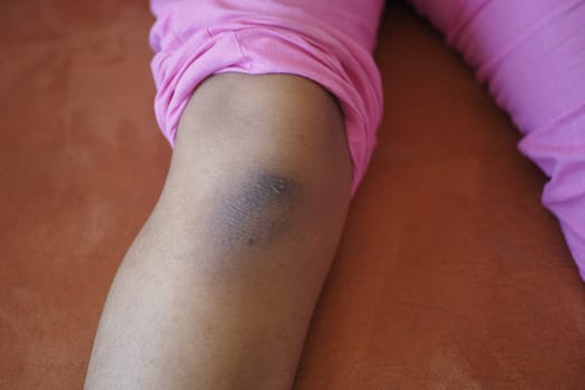 stain bruise wound on kid knee..