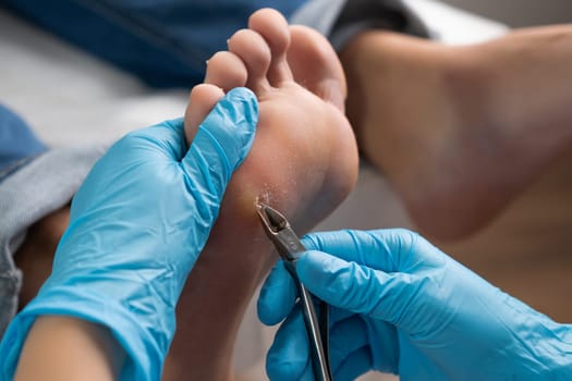 Close up removing a callus on a womans foot by nippers.