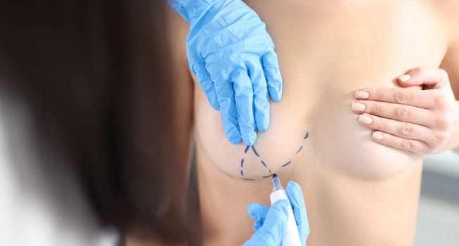 Plastic surgeon drawing preoperative markings on patient chest closeup. Breast augmentation surgery concept