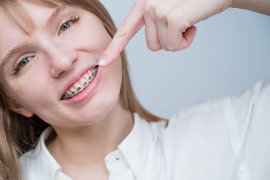 A beautiful red-haired girl smiles and points to the braces. Young woman corrects bite with orthodontic appliance.