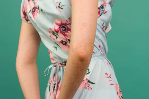 CLOSE UP: Unrecognizable young woman suffering from autoimmune incurable dermatological skin disease called psoriasis. Red, inflamed, scaly rash on elbows. Psoriatic arthritis