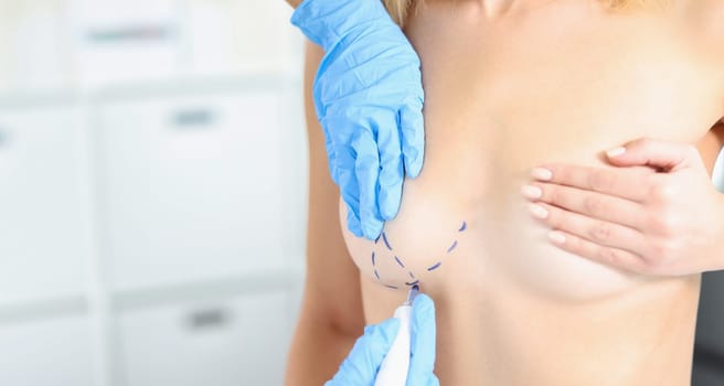 Doctor draws marks on female breast before cosmetic surgery operation. Enlargement and lift of female mammary glands concept