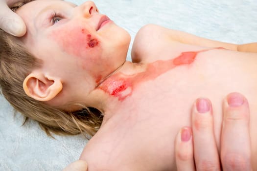 medical procedure dressing a boy with a first-degree burn from boiling water on his face, neck and chest