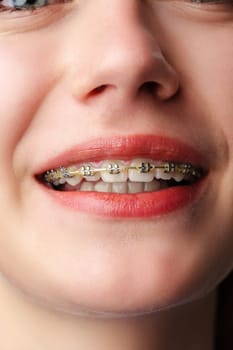 Young woman with dental braces close up photo