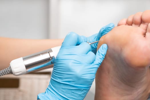 A podologist using electric drill removes a callus from a womans foot at the medical center