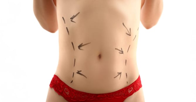 Female body stomach with markup before liposuction shaping surgery for surgeon concept closeup