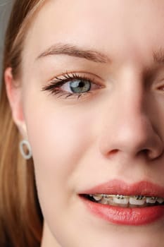 Young woman with dental braces close up photo