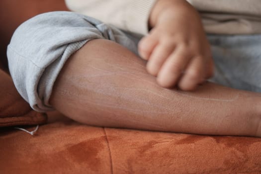 a kid suffering from itching skin on feet .