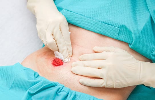 A young Caucasian male patient in medical disposable pajamas and in sterile surgical white gloves wipes with a dry cloth around the colon to replace the colon after surgery at home, flat lay close-up. Medical concept, abdominal diseases, surgery, step by step instructions.