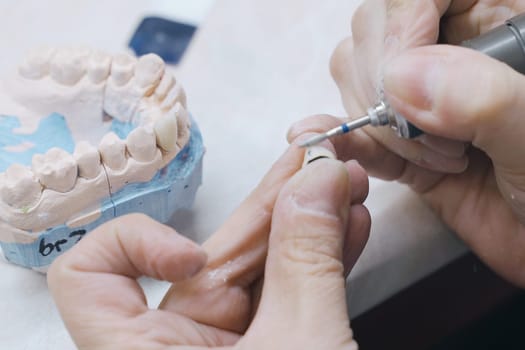 A dental technician grinds prosthetic human teeth. Close-up