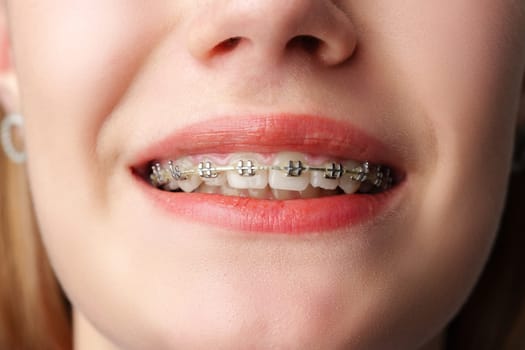 Young woman with dental braces close up photo